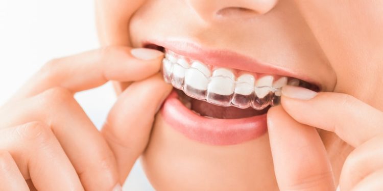 Three Things You Might Not Know About Wearing Invisalign Aligners