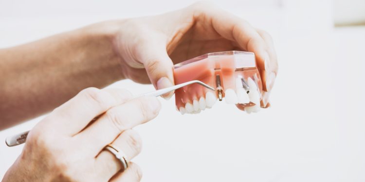 Understanding the Dental Implant Process