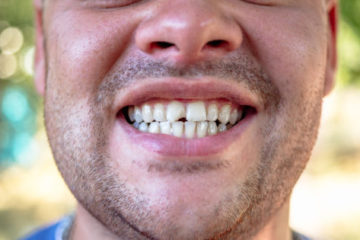 You Have a Chipped Tooth. What Now?