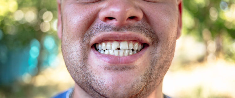 You Have a Chipped Tooth. What Now?