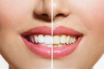 Understanding the Safety of Tooth Whitening