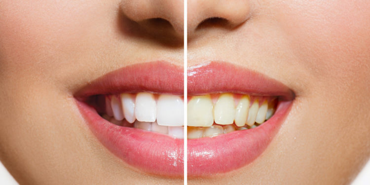 Understanding the Safety of Tooth Whitening