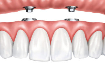 How Implants Can Bring New Life to Your Dentures