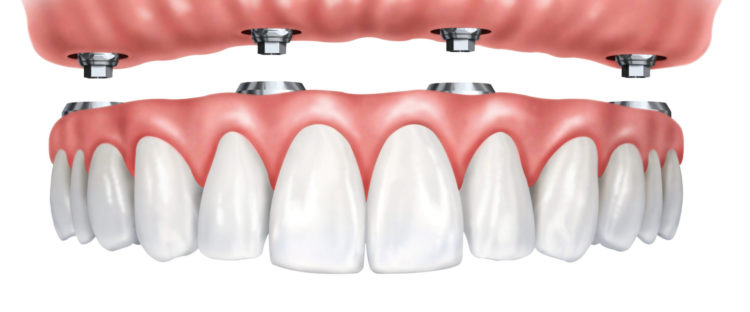 How Implants Can Bring New Life to Your Dentures
